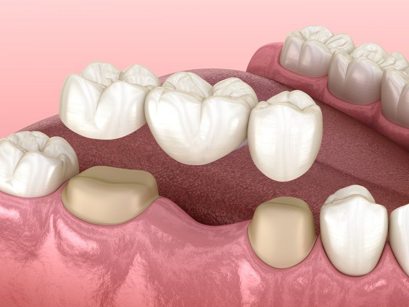 A computer generated image of a dental bridge in a person 's mouth.