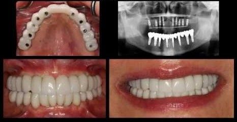 A collage of photos of a person 's teeth and a x-ray of their teeth.