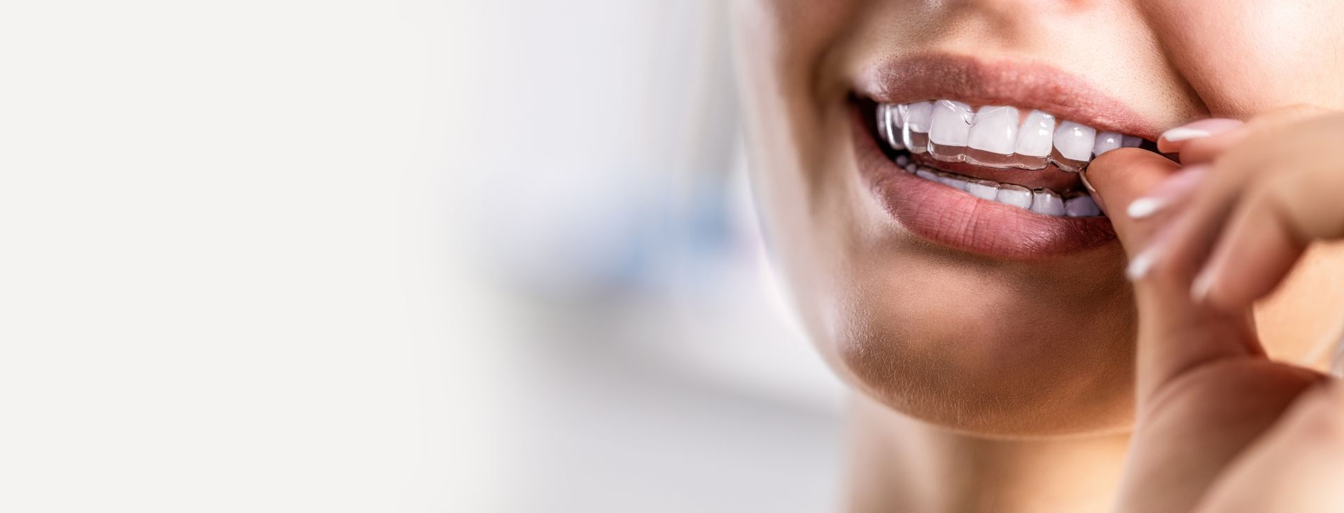 Sbiancamento dentale