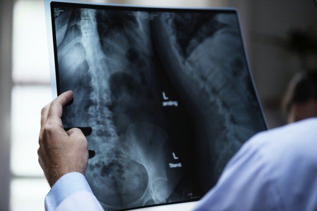 Spine X-ray — Villa Park, CA — Villa Park Chiropractic