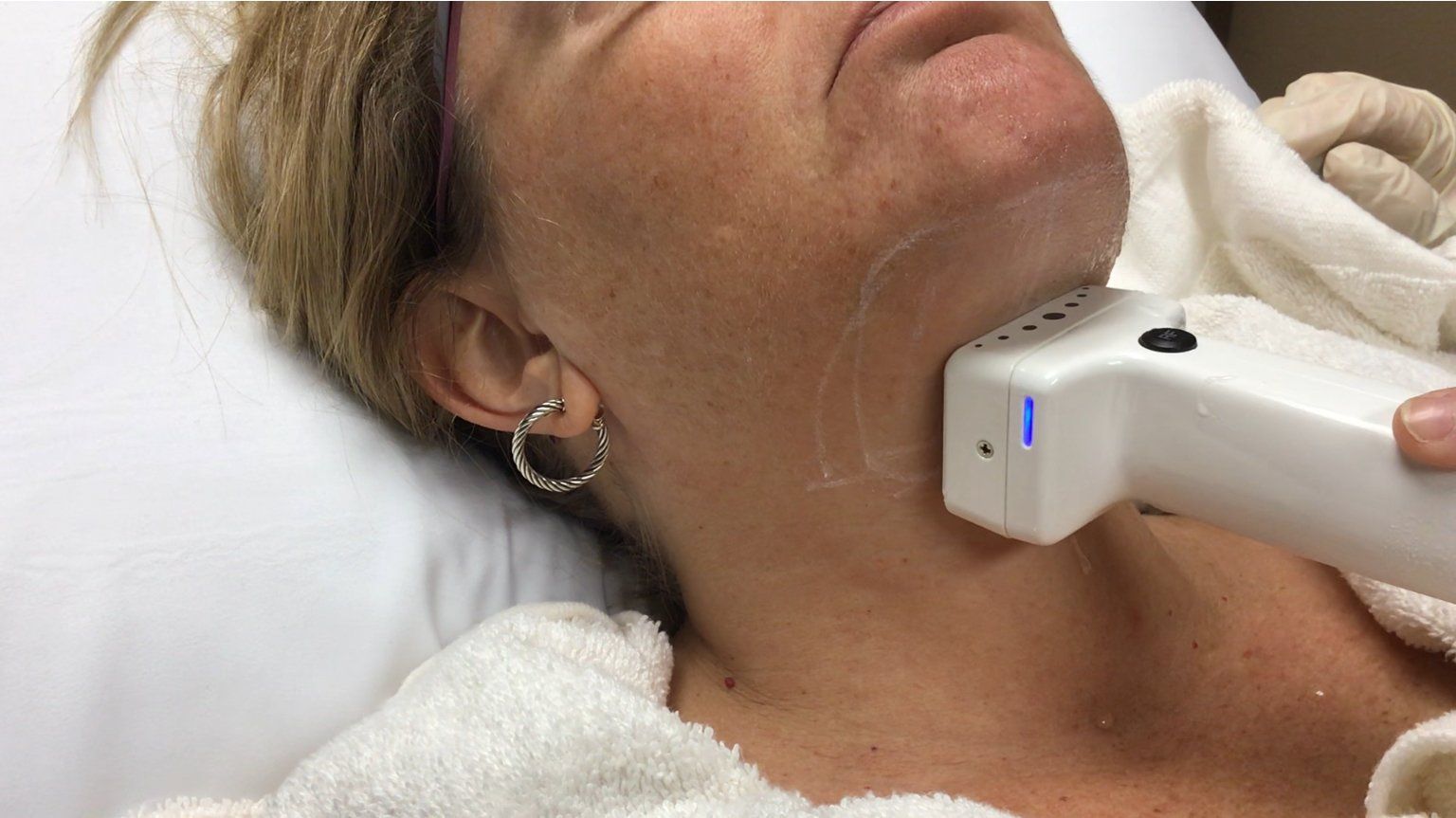 Surgical Treatment — Merritt Island, FL — Neo Laser Medical Spa