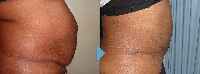 Before & After Tummy Tuck Procedure