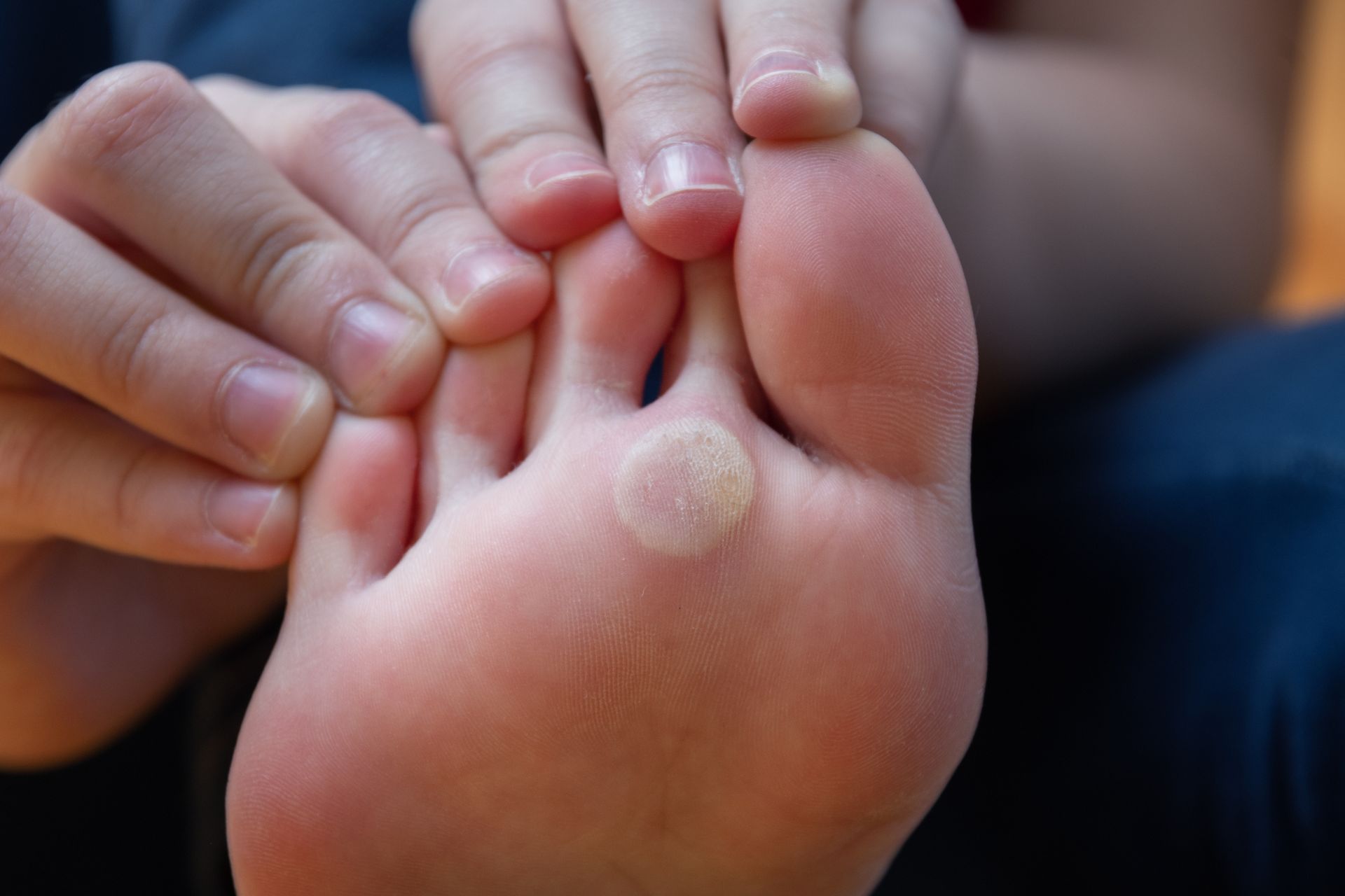 Corns and Calluses | Bel Air, MD | Foot Center Of Bel Air
