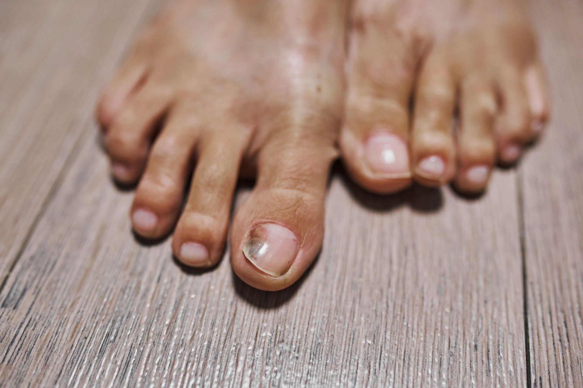 Painful Nails | Bel Air, MD | Foot Center Of Bel Air