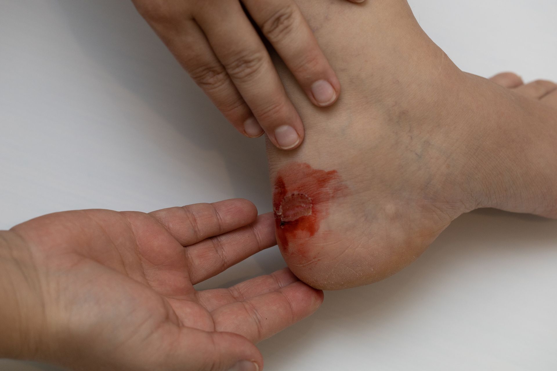 Wound Care | Bel Air, MD | Foot Center Of Bel Air