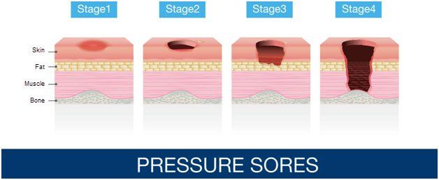 Pressure Sores Chart Two — Chattanooga, TN — Houston & Alexander, PLLC