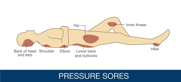 Pressure Sores — Chattanooga, TN — Houston & Alexander, PLLC