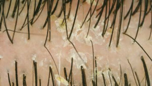 A close up of a person 's hair with dandruff on it.