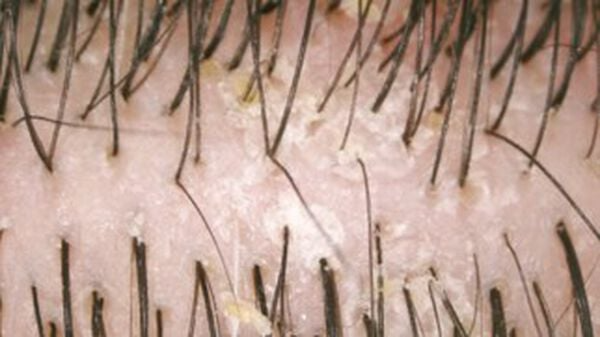 A close up of a person 's hair with dandruff on it.