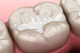Tooth with a white filling on a pink background.
