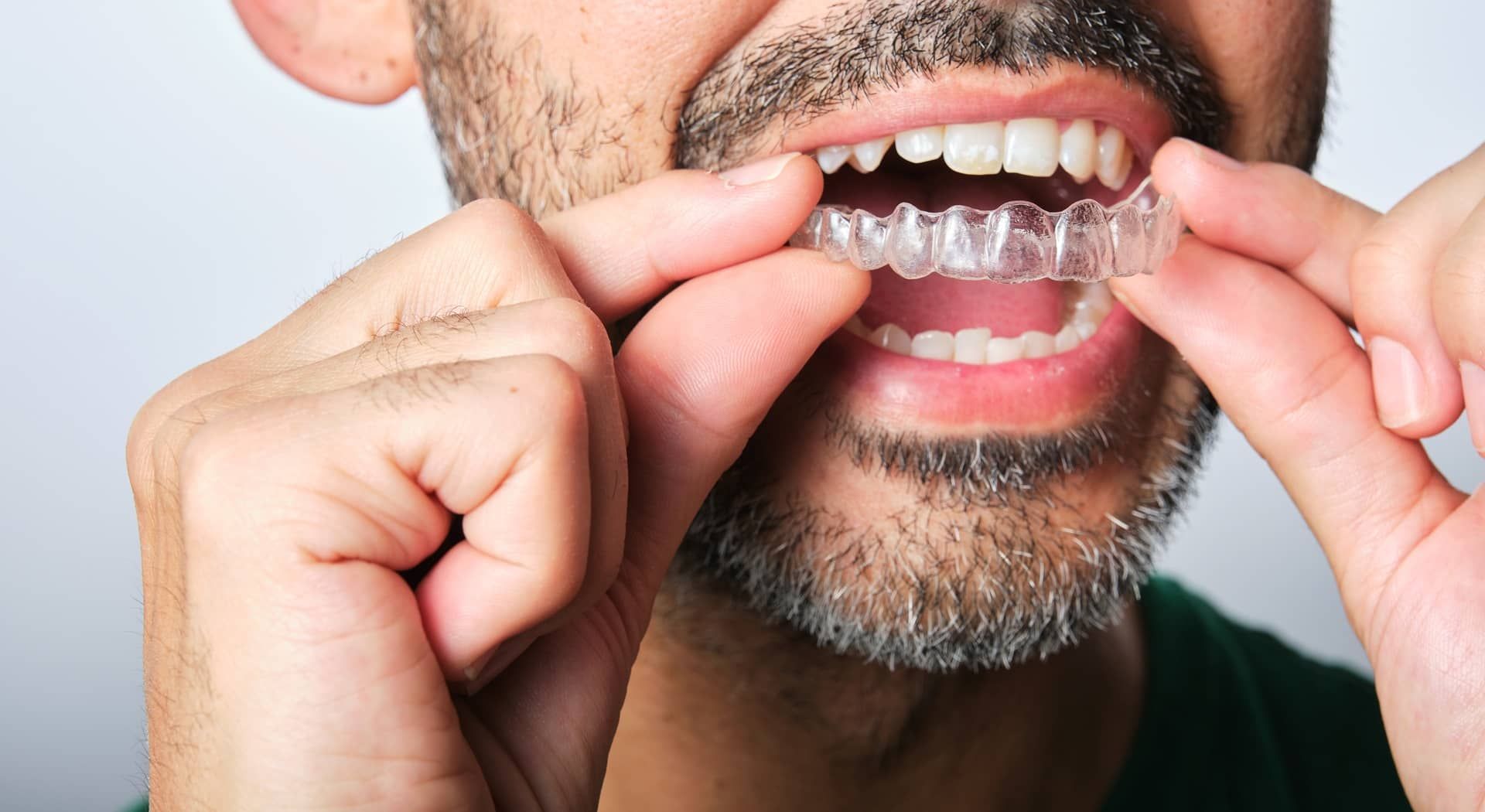 Adult braces in Fort Bragg, NC