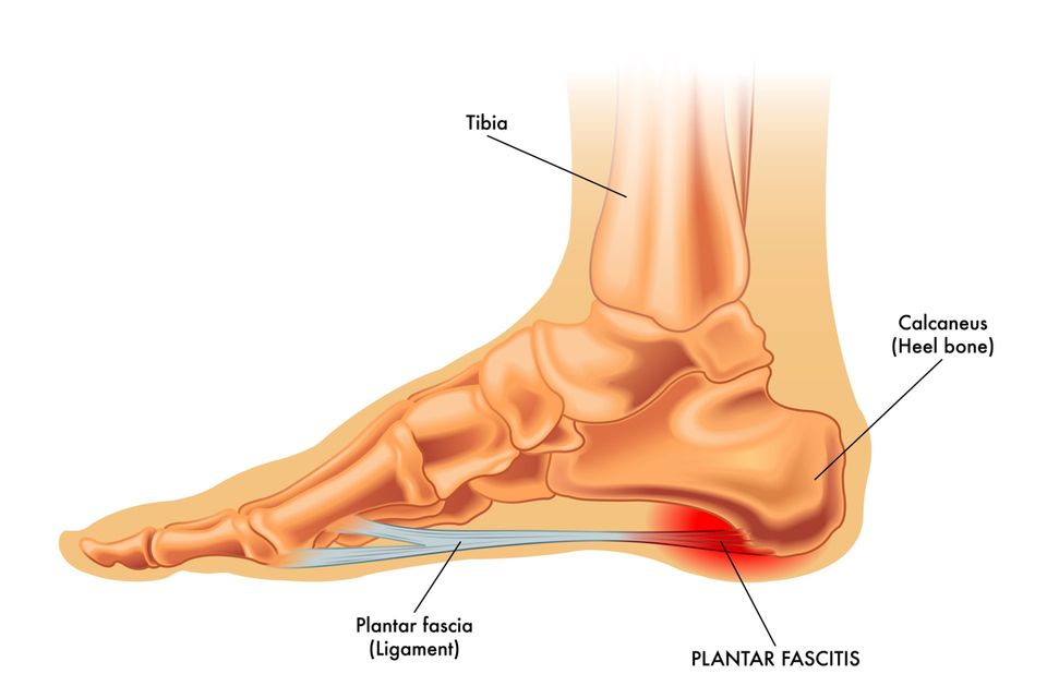 Inflammation in the deals heel of the foot