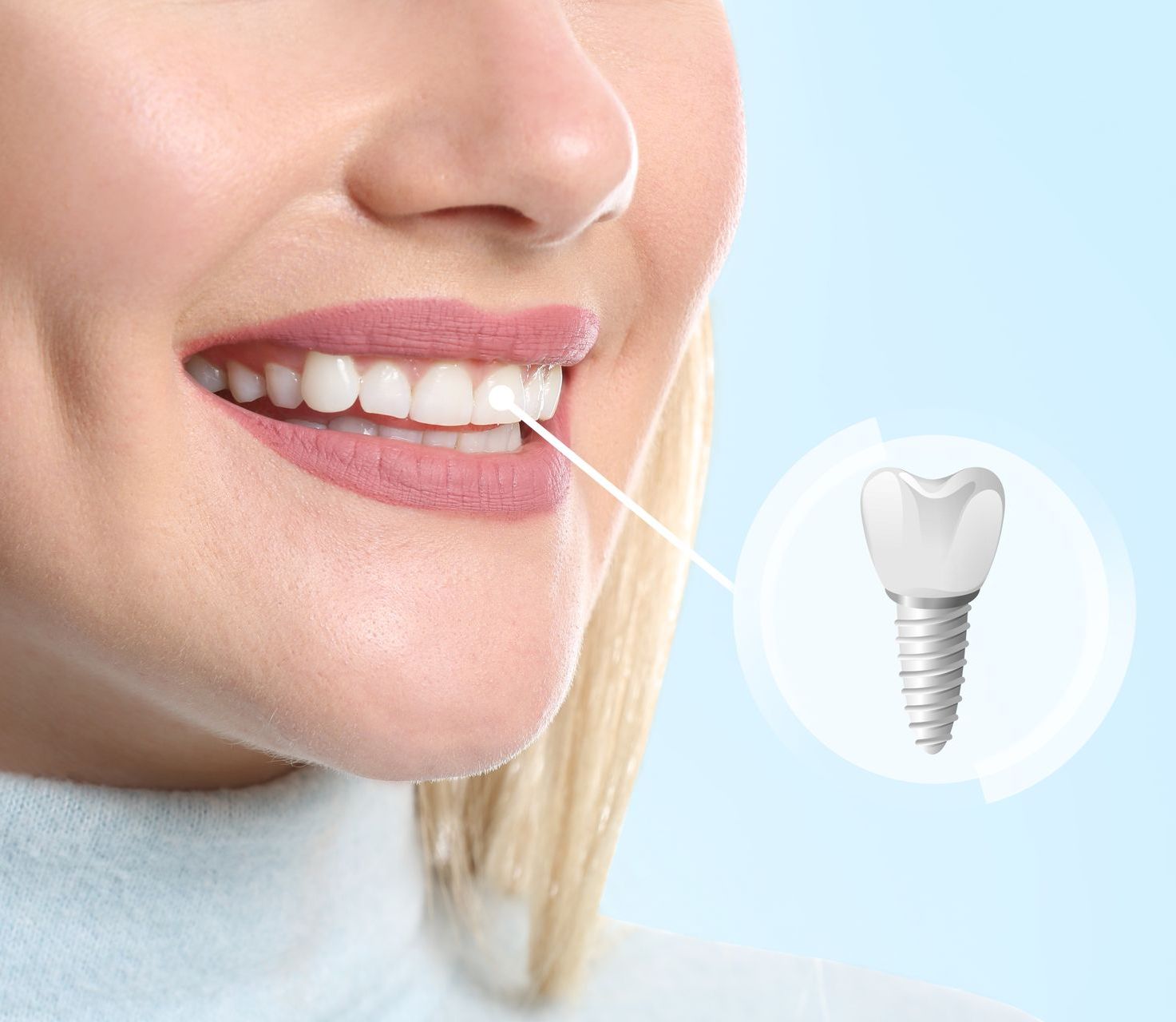 Ceramic Zirconia Implants