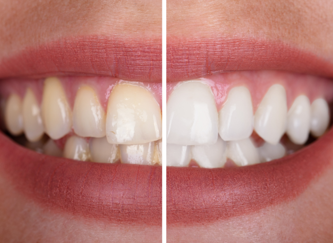 before and after teeth whitening in Oak Point TX 75068