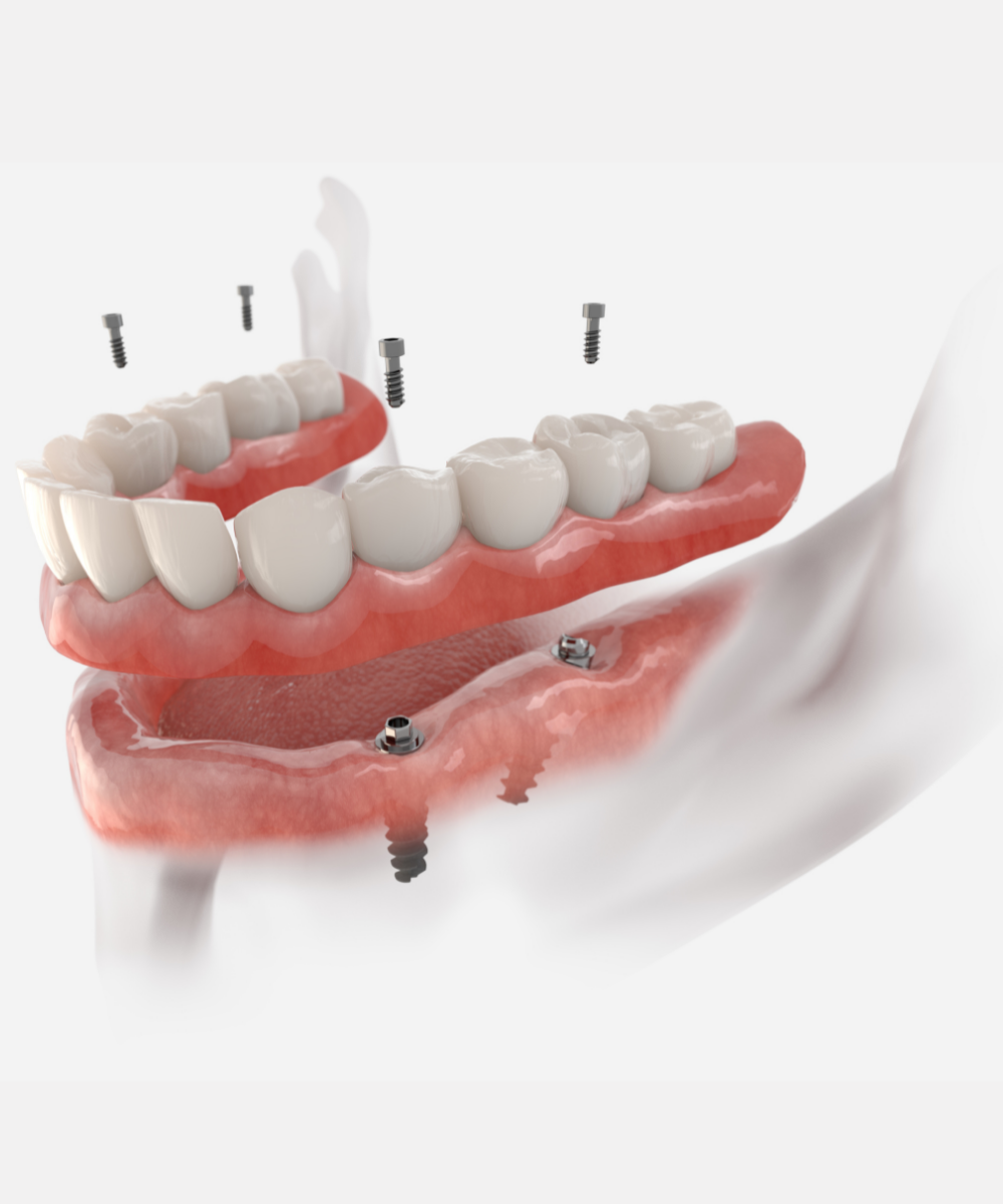 A model of a denture with screws in it