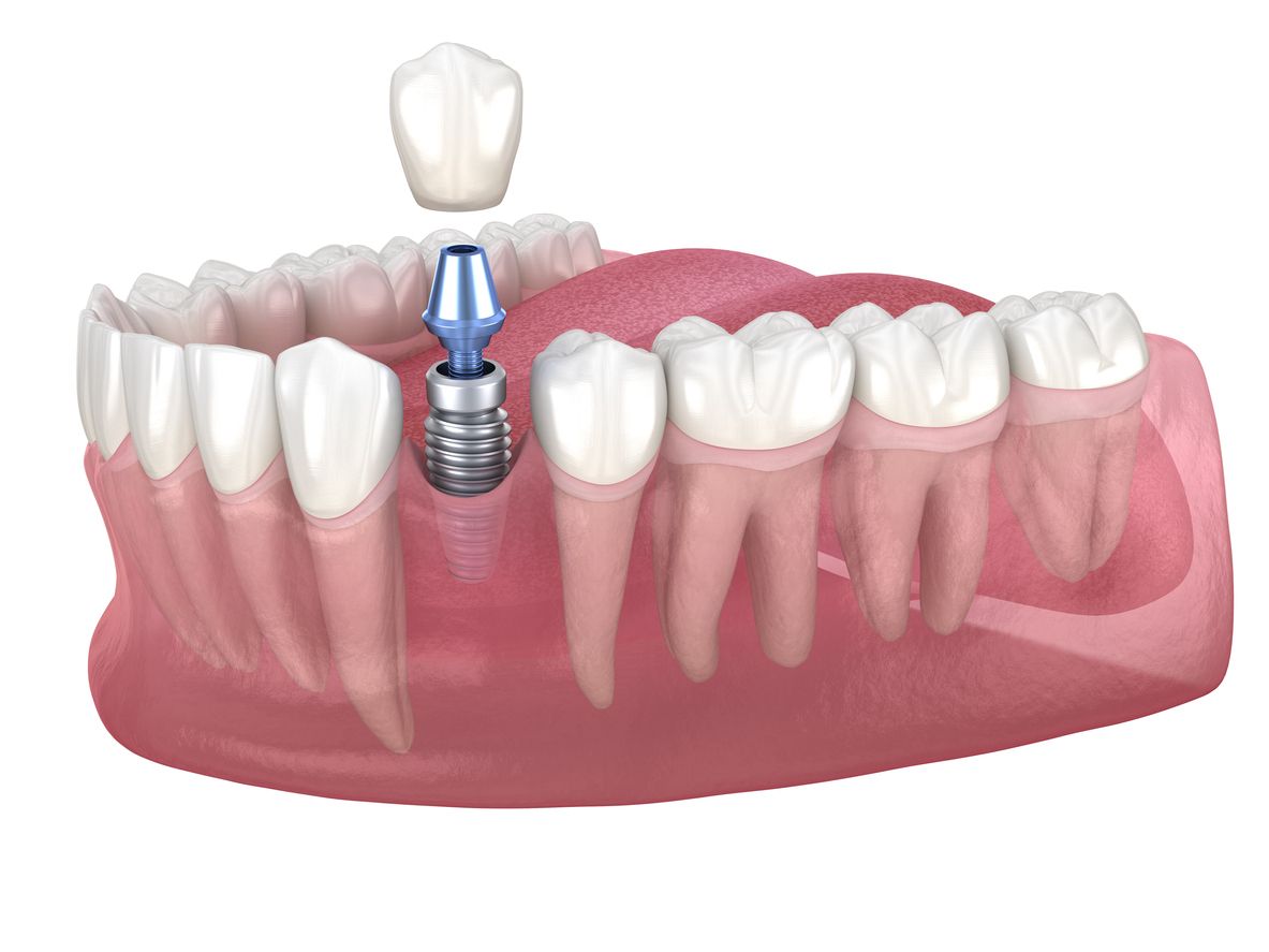 A model of a tooth with a dental implant and a crown.