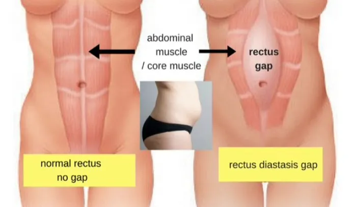 Abdominoplasty or Tummy Tuck Surgery with Dr Marco