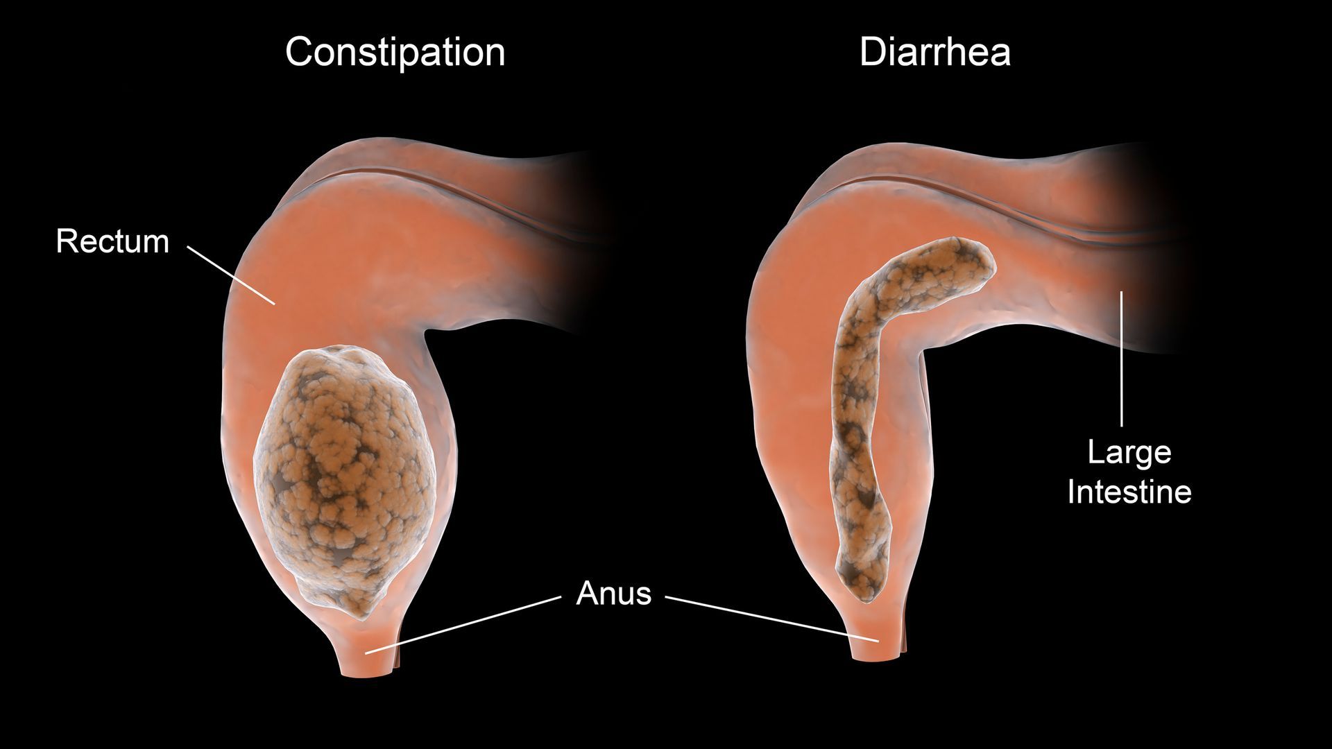 Fecal Incontinence | Newburgh, IN | Evansville Colorectal
