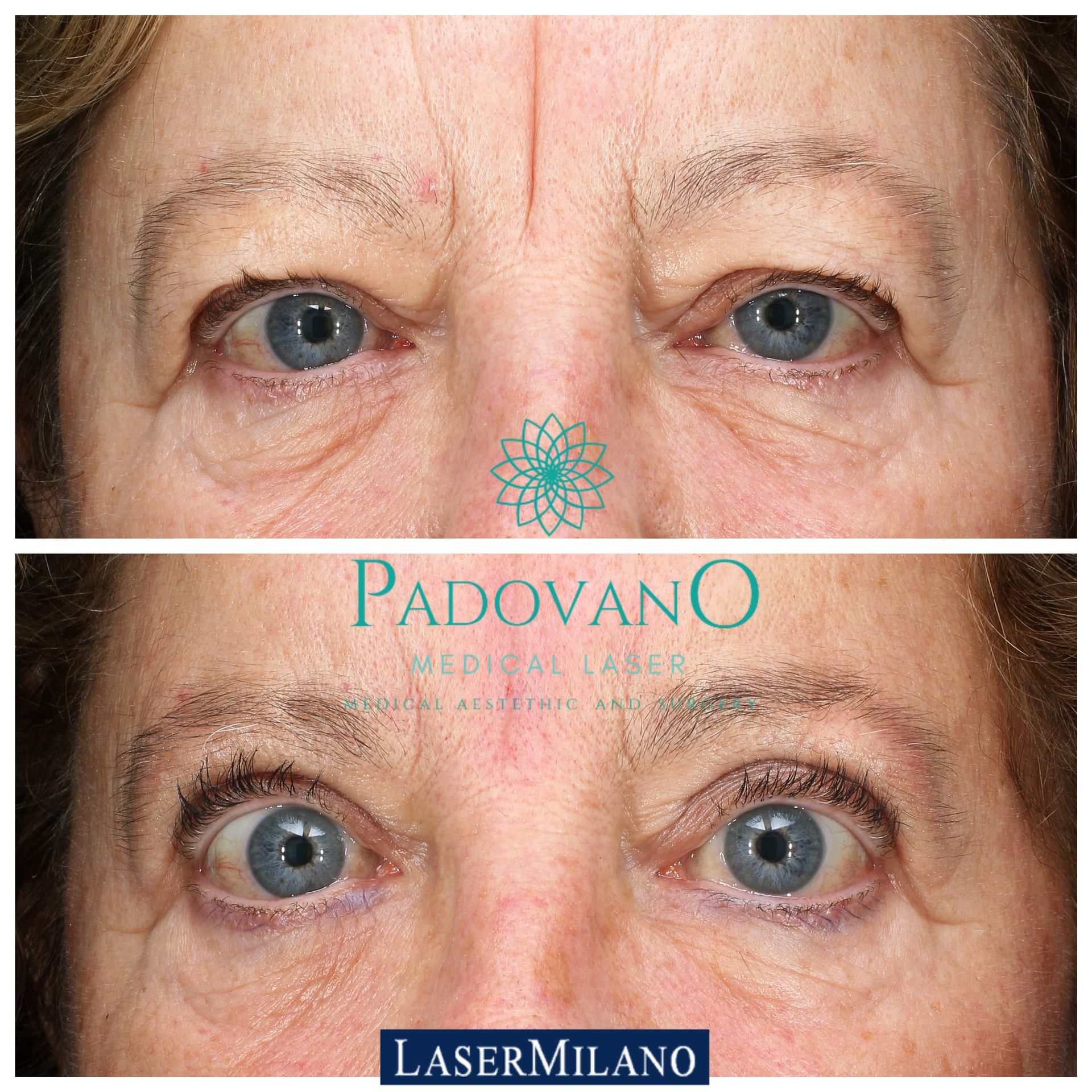 Una foto prima e dopo degli occhi di una donna