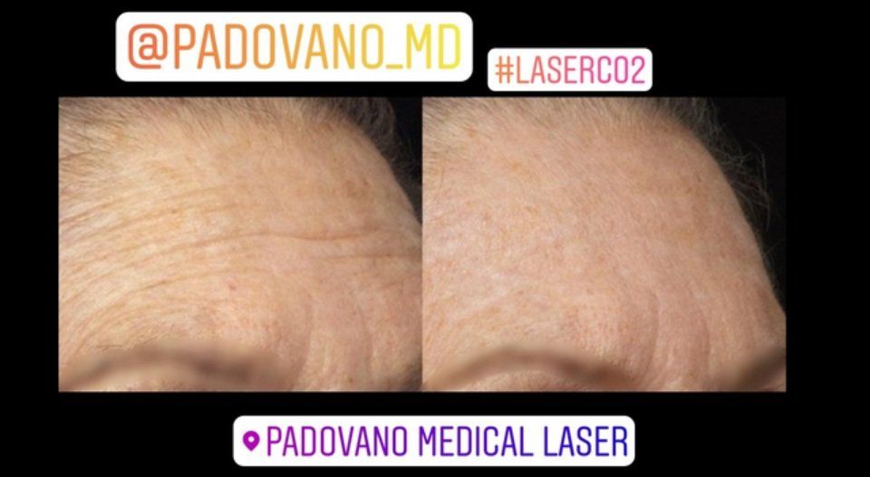 laser resurfacing