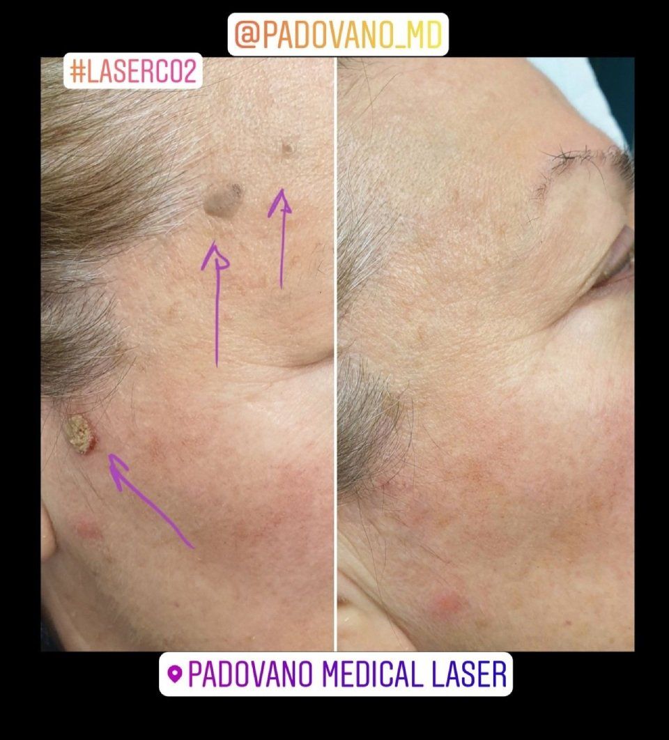 intervento di laser resurfacing 4