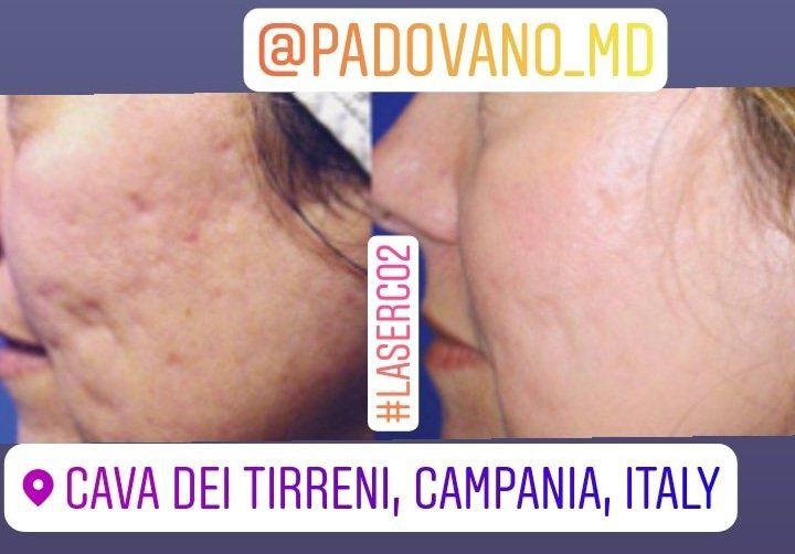 intervento di laser resurfacing 5