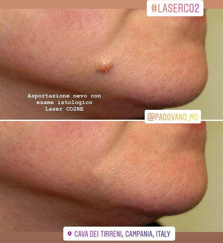 intervento di laser resurfacing 6