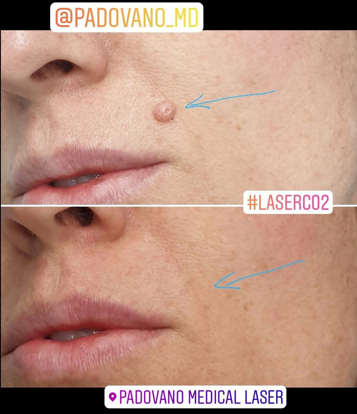 intervento di laser resurfacing 9