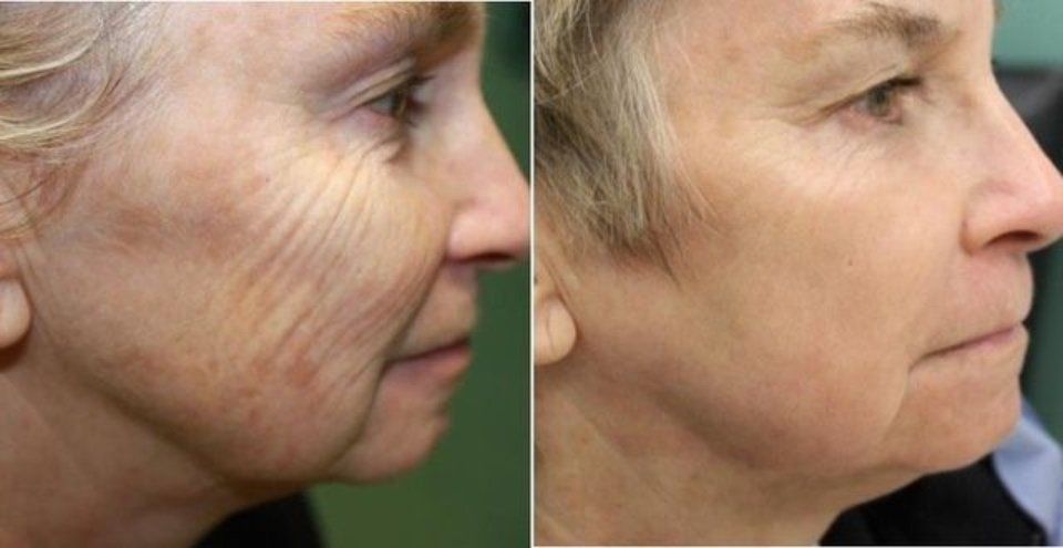 Applicazione laser CO2RE 6