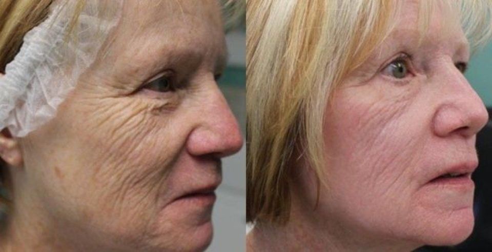 Applicazione laser CO2RE 3