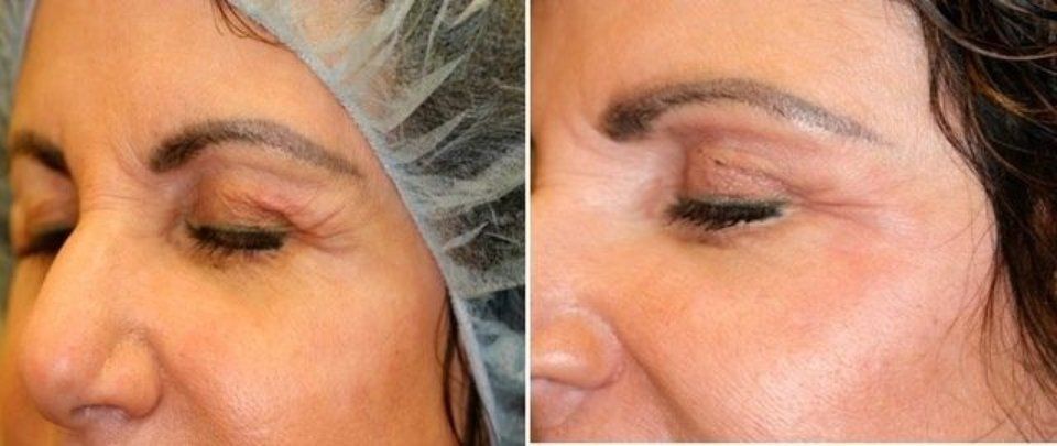 Applicazione laser CO2RE 5