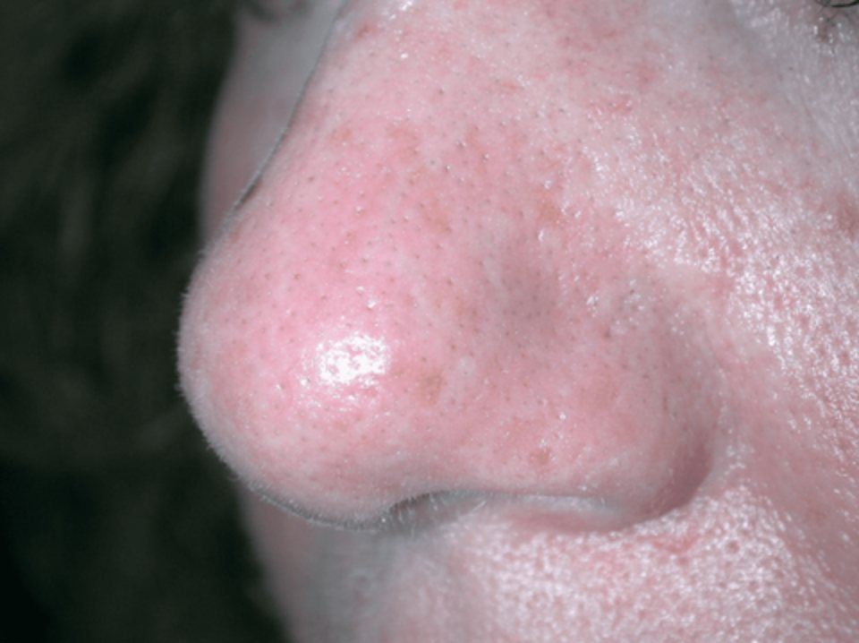 Laser vascolare viso dopo