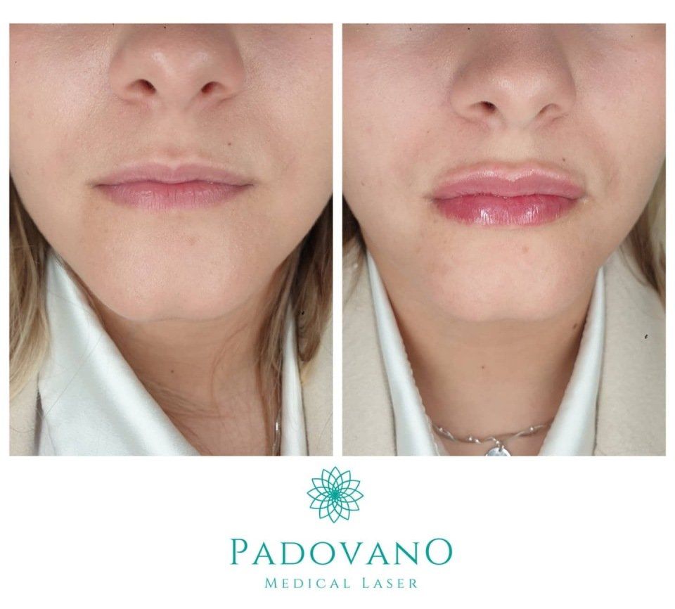filler labbra padovano