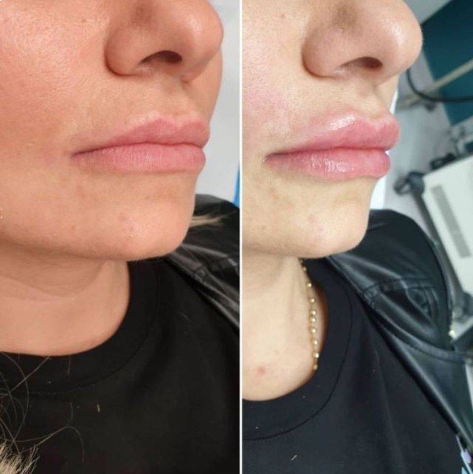 Trattamento labbra prima e dopo