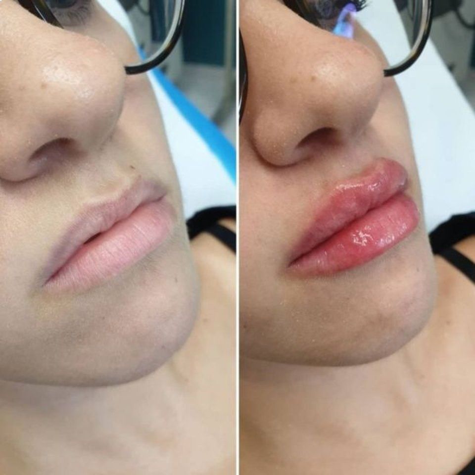 Filler labbra prima e dopo