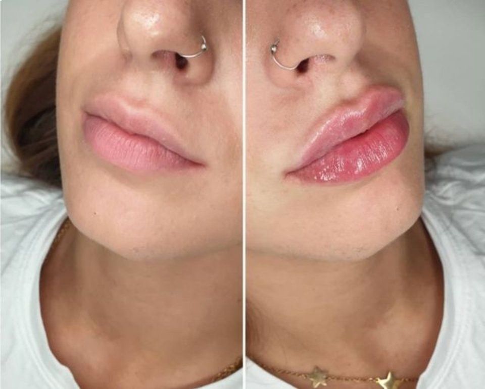 Labbra con filler prima e dopo