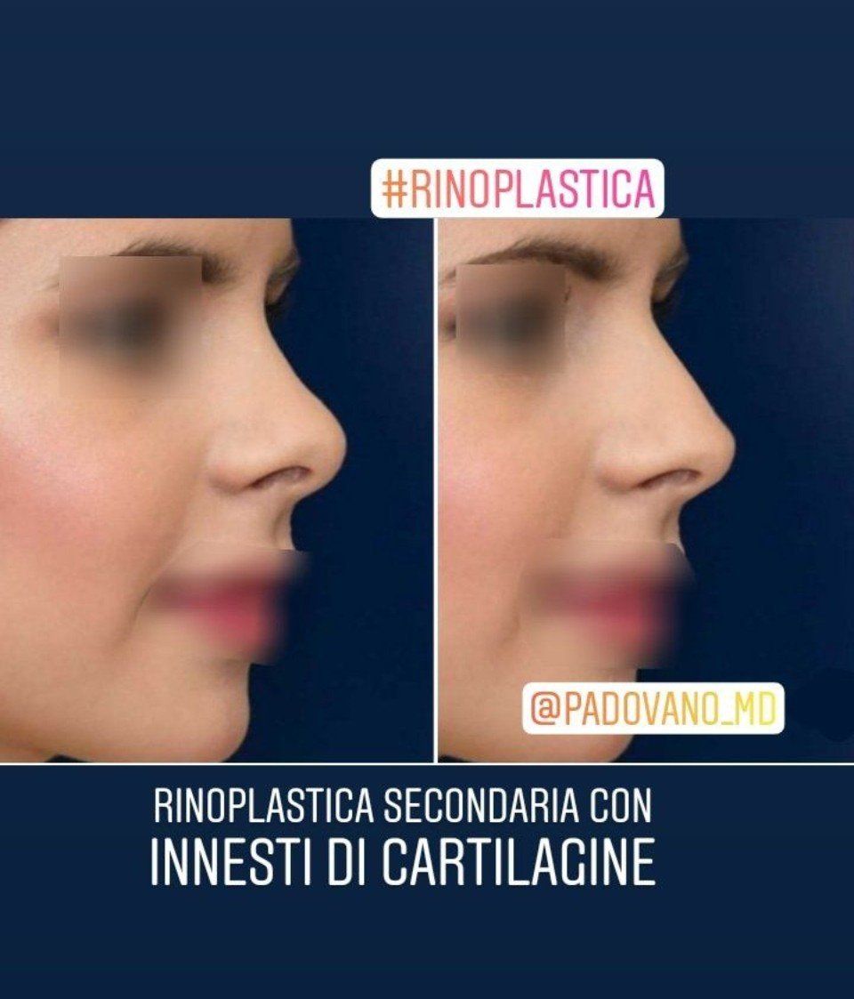 Rinoplastica 4