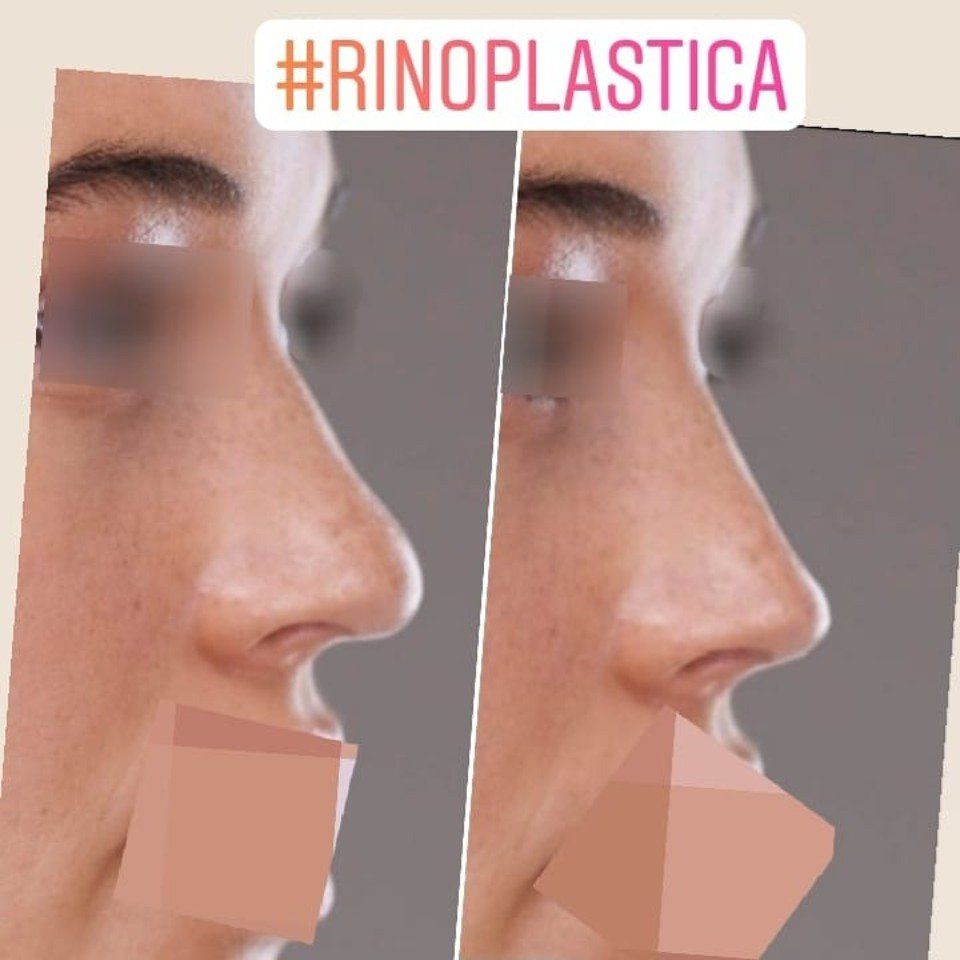 Rinoplastica 2