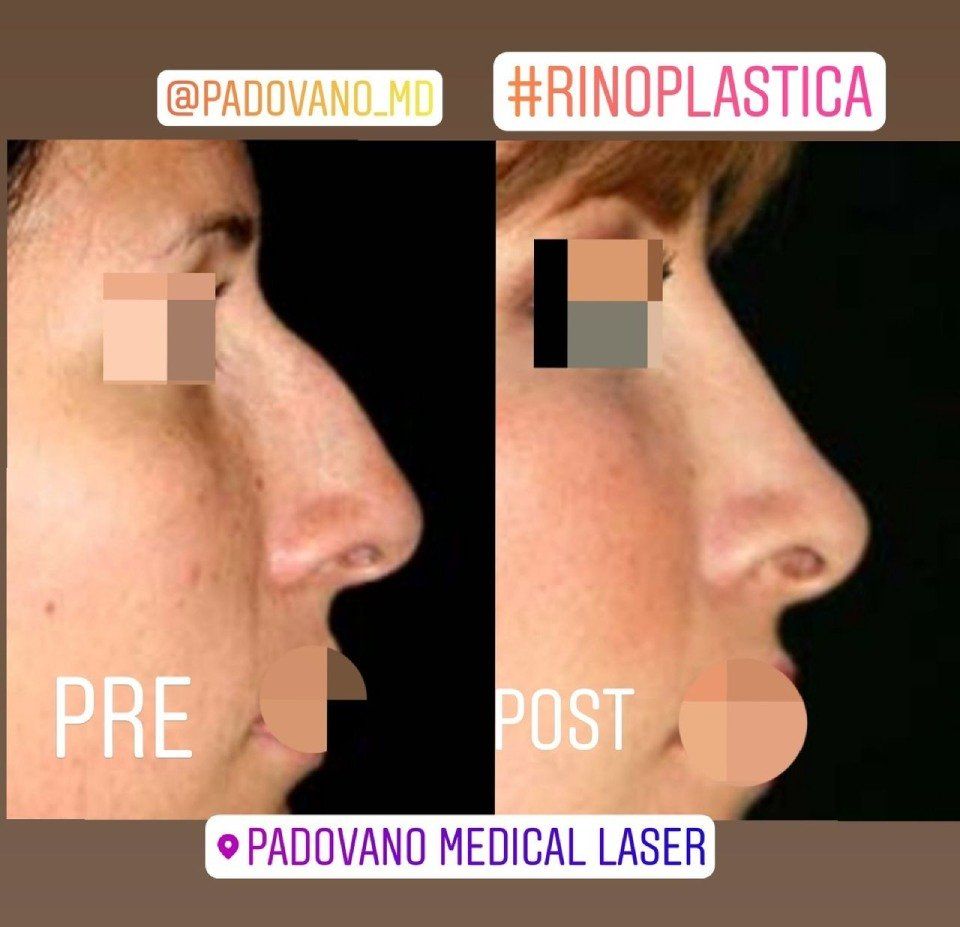Rinoplastica 6