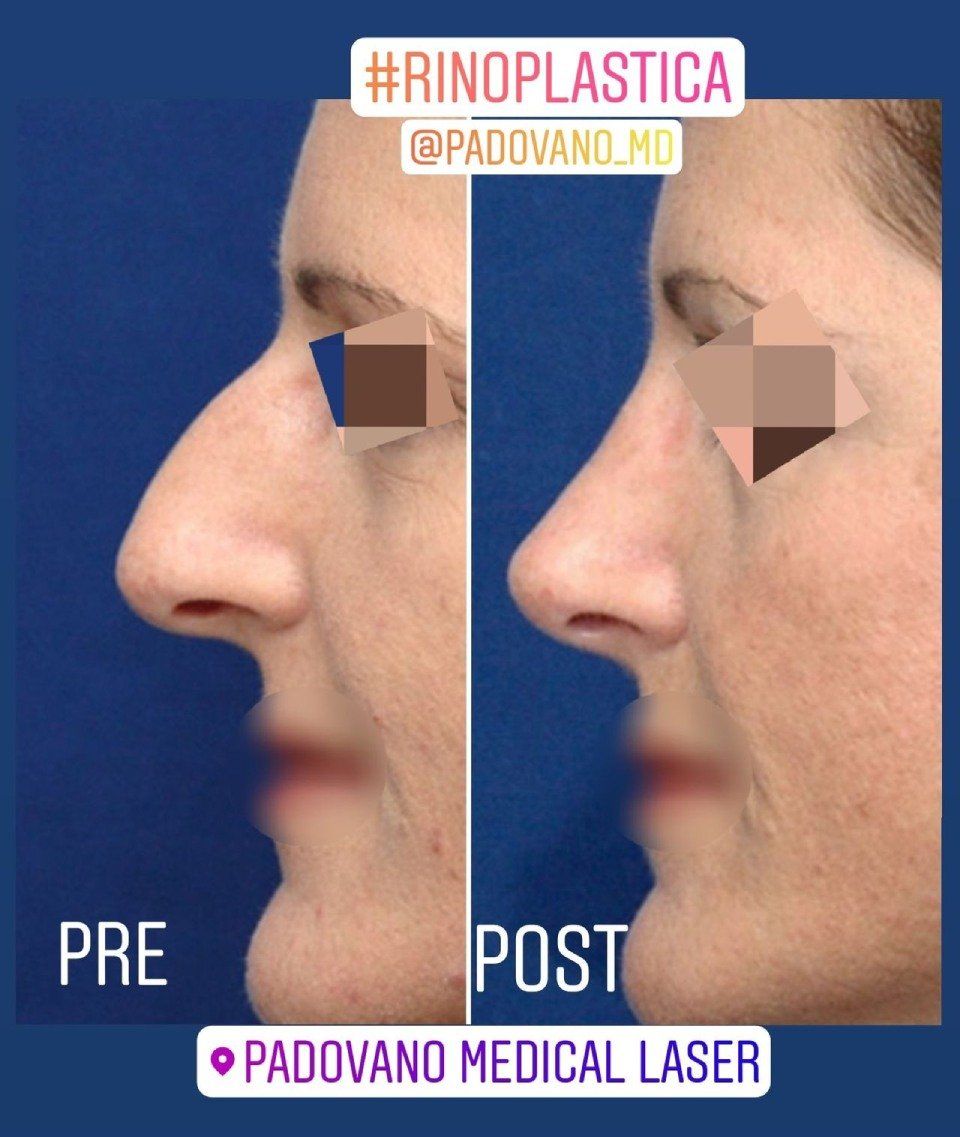 Rinoplastica 8