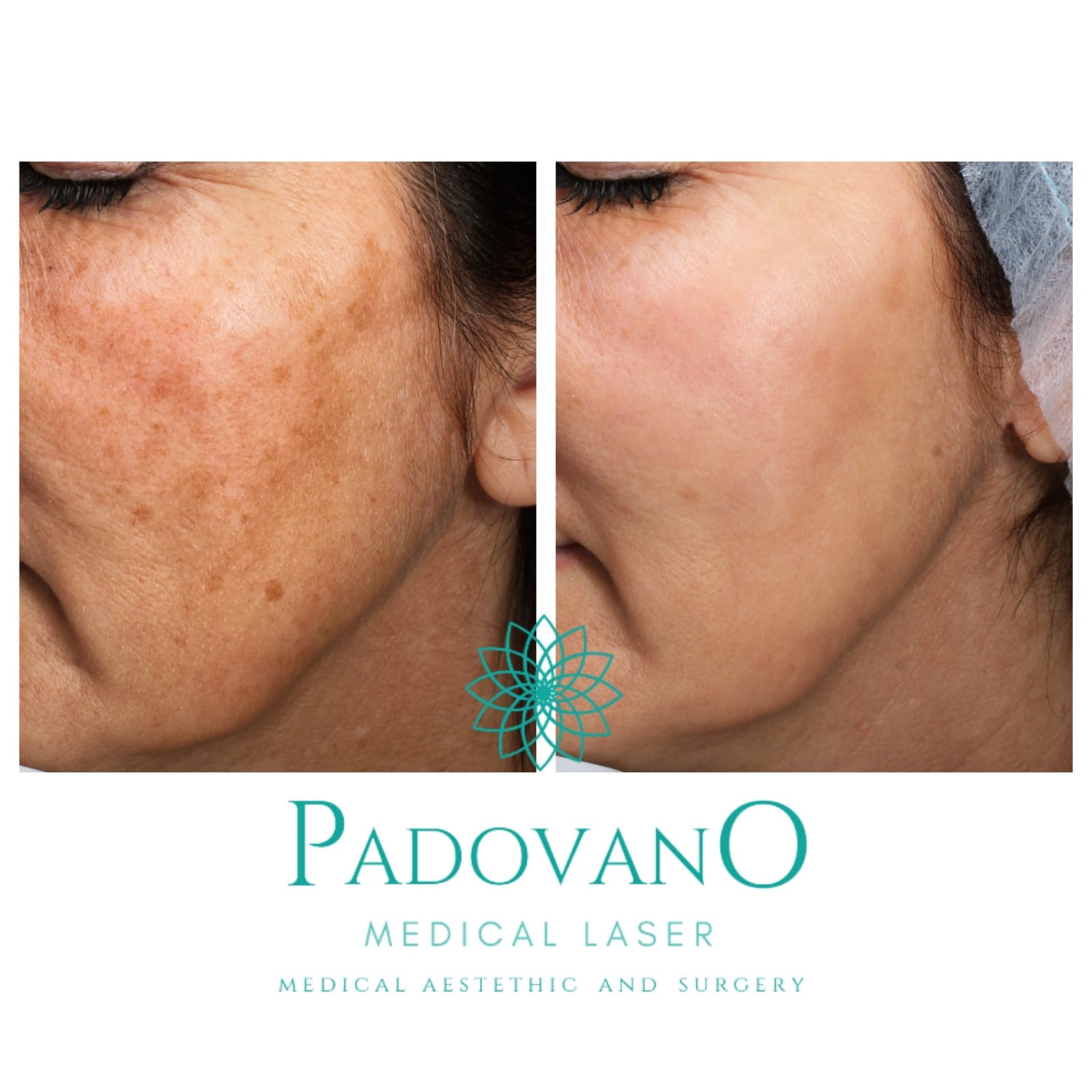 Una foto prima e dopo del viso di una donna con le parole padovano medical laser medical aesthetic and surgery in basso