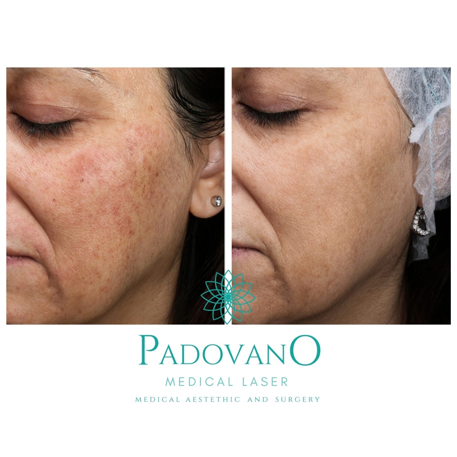 Una foto prima e dopo del viso di una donna dal laser medico padovano