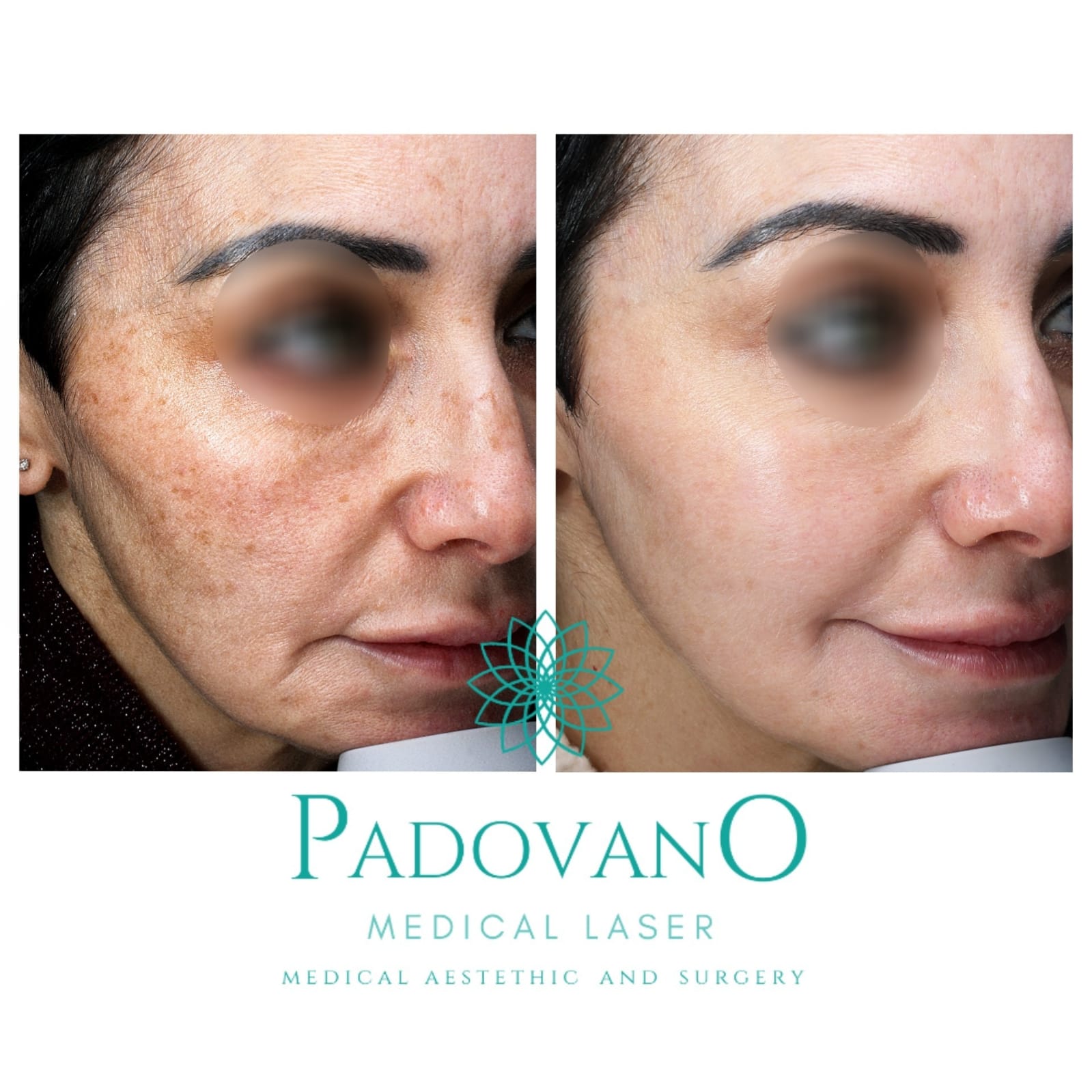 Una foto prima e dopo del viso di una donna con le parole padovano medical laser medical aesthetic and surgery