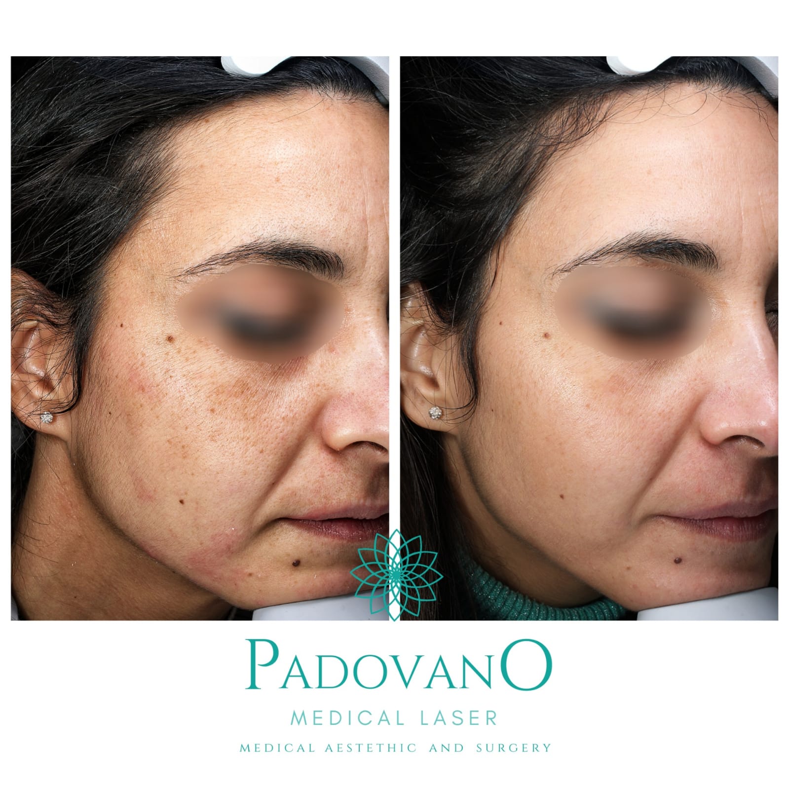 Una foto prima e dopo del viso di una donna