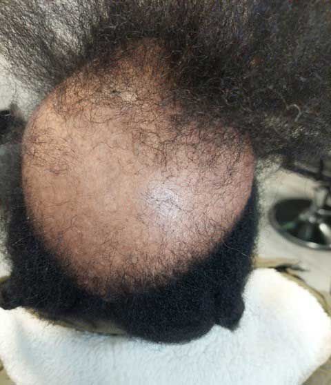 A close up of a man 's bald head with a beard.