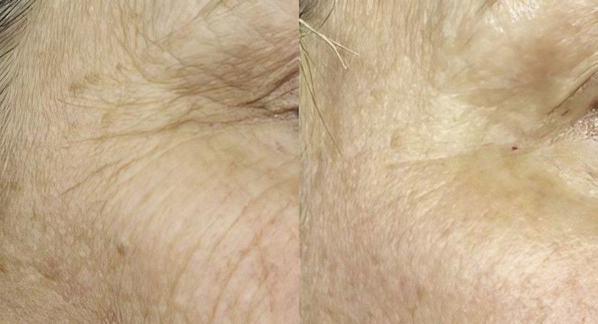 A Close up Of an Elderly Woman's Face with Wrinkles — Skin Exquisite Laser & Cosmetic Clinic in Port Macquarie, NSW