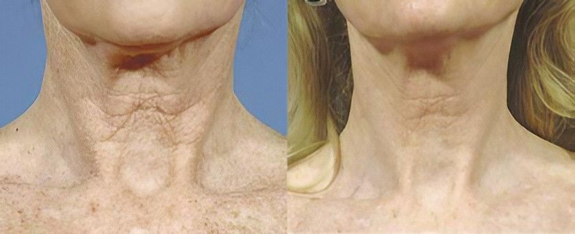 A Before and After Photo of A Woman's Neck and Chest — Skin Exquisite Laser & Cosmetic Clinic in Port Macquarie, NSW