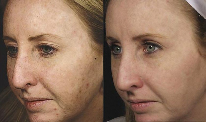 A Before and After Photo of A Woman's Face with Freckles — Skin Exquisite Laser & Cosmetic Clinic in Port Macquarie, NSW