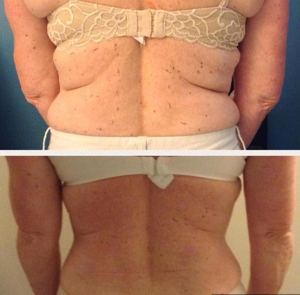 After results of Lyft non-surgical lipo treatment