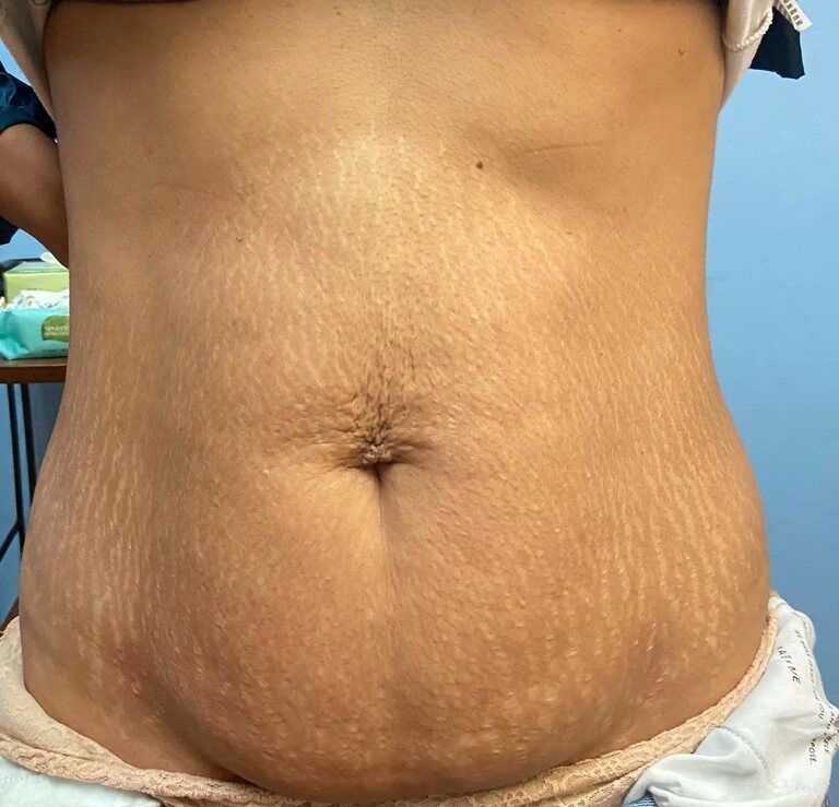 Client's body after treatment by Body Lyft System.